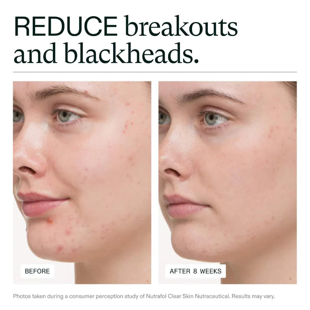 Before and after comparison of a person's face with text indicating reduction of breakouts and blackheads.