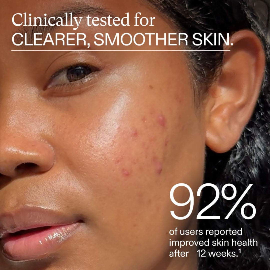 Close-up of a person's face with acne, promotional text about clinical testing for clearer, smoother skin.
